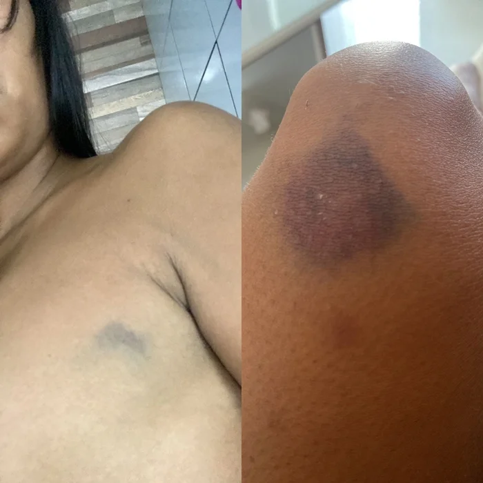 Mulher diz ter sido agredida pelo amante na Bahia; suspeito, vereador de Queimadas nega