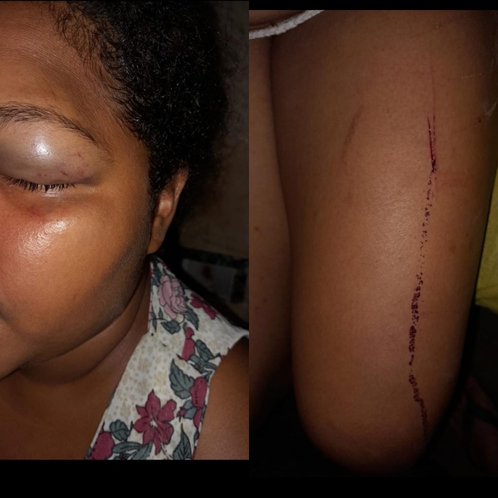 Briga na Festa dos Vaqueiros: mãe e filha denunciam homem por agressões em Queimadas; ele se defende