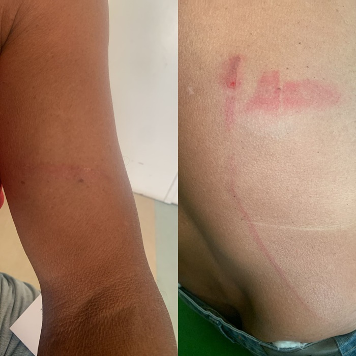 Idoso é espancado com enxada após discussão por colchete, em Queimadas